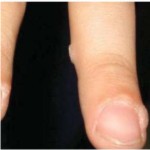 бородавка, красота, болезнь, здоровье