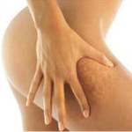 целлюлит, похудение