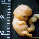 невынашивание беременности