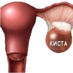 гинекология, киста, заболевания, женщина, здоровье